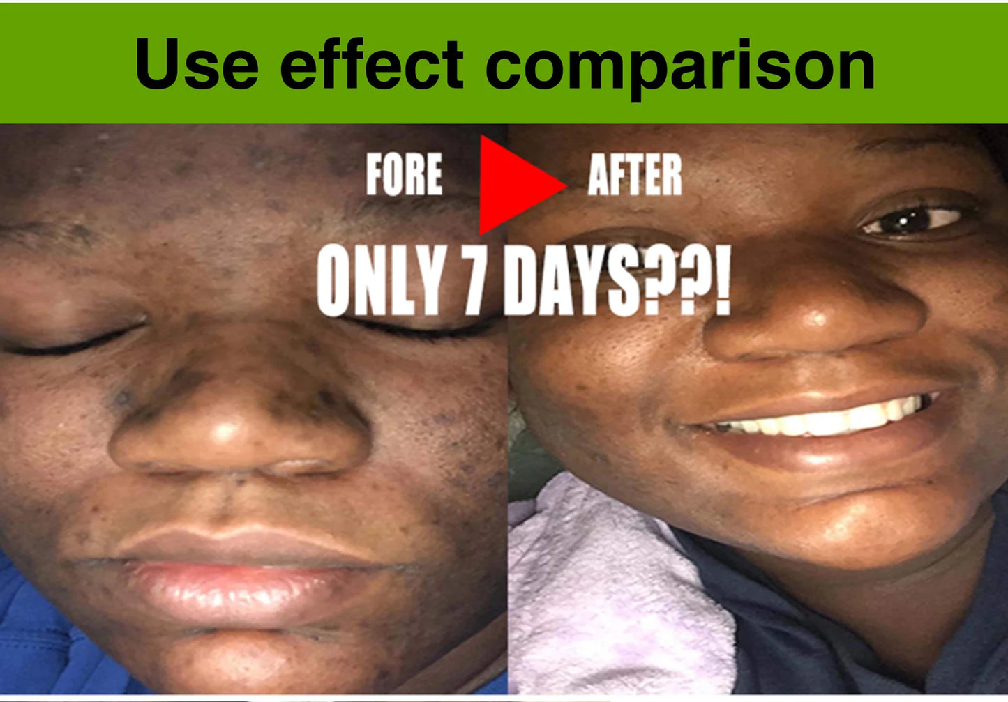 AILKE Aloe Vera Whitening Soap for Acne and Radiant Skin