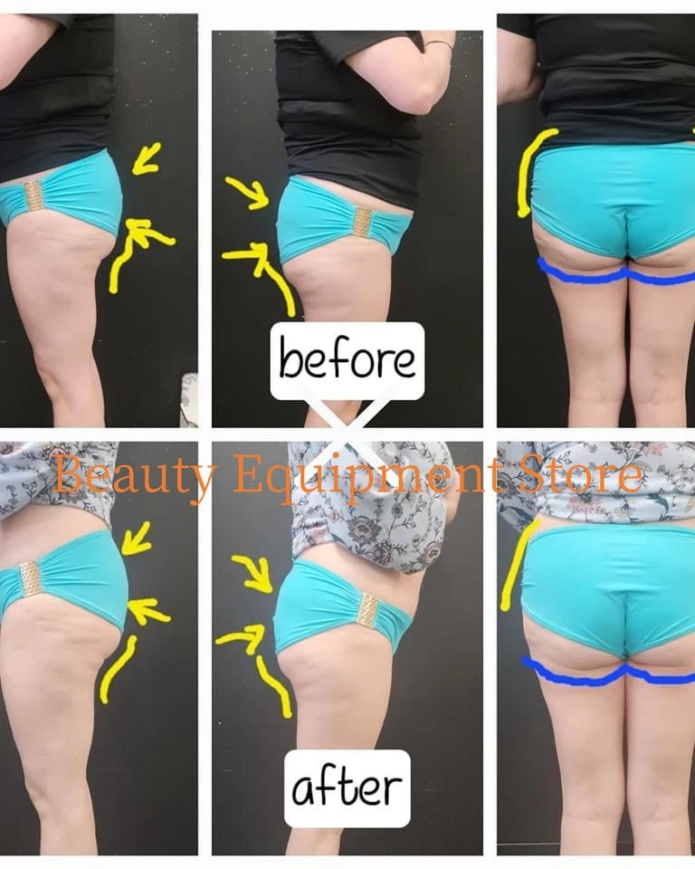 EMS Body Sculpt Machine Fat Burner 4 Handles For Slimming