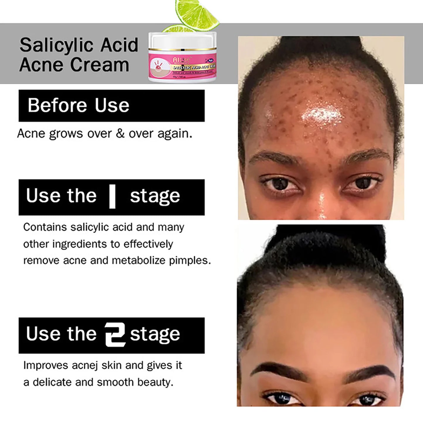 AILKE Organic Acne Face Cream Clear Skin And Oil Control