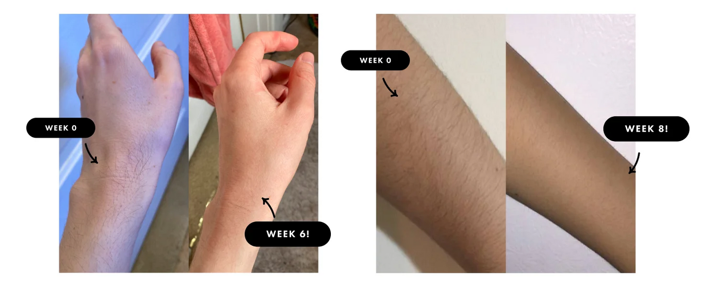 JOOYEE IPL Hair Removal Device With Auto Flash 9 Gear