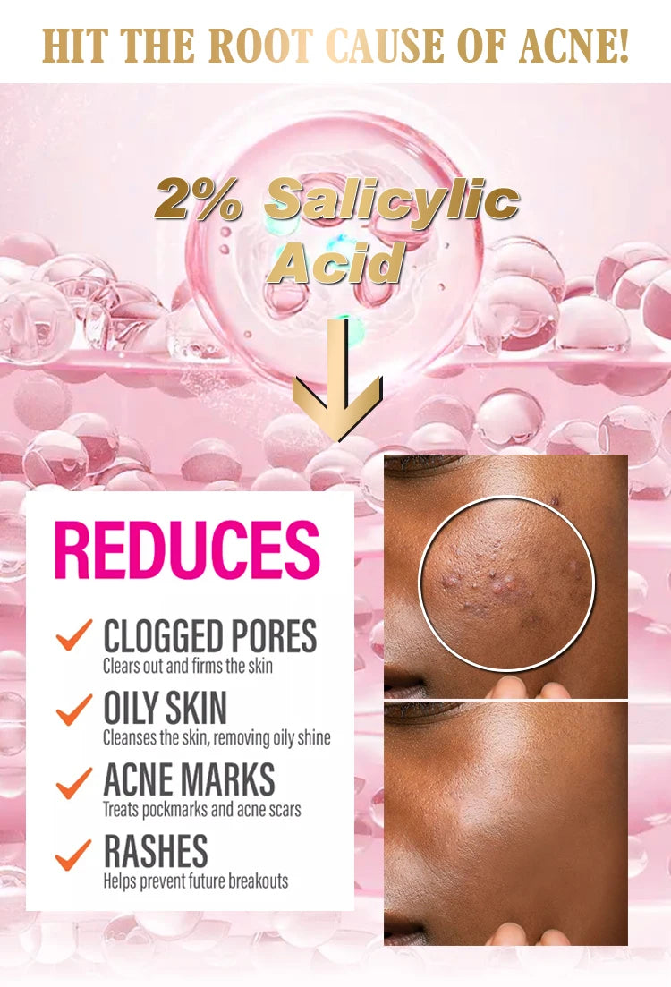 AILKE Organic Acne Face Cream Clear Skin And Oil Control