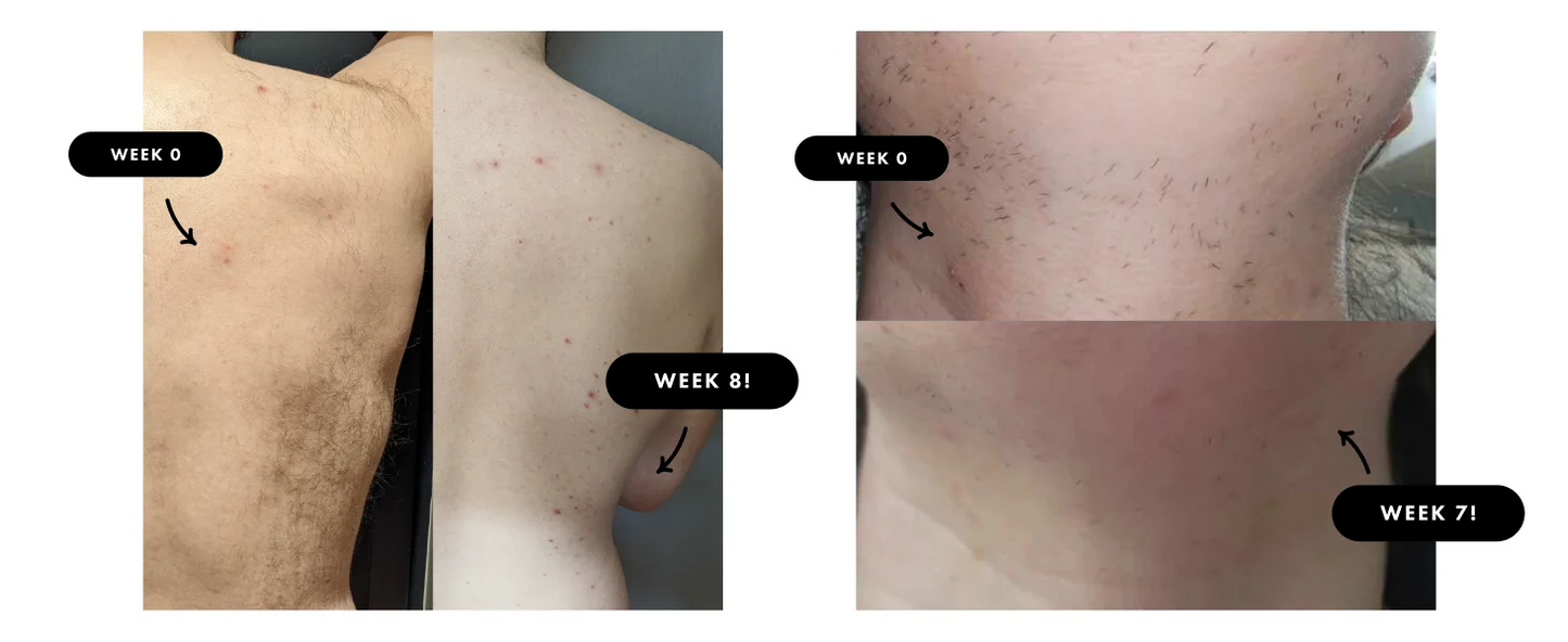 JOOYEE IPL Hair Removal Device With Auto Flash 9 Gear